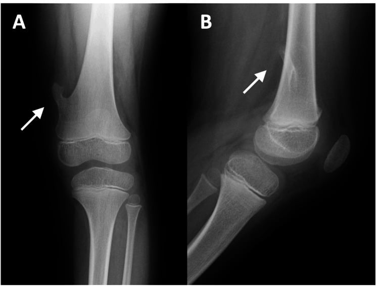 AP and lateral radiographs of a long-stalk pedunculated osteochondroma arising from the medial distal femur