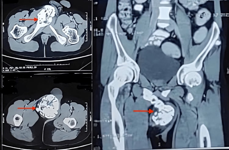 Axial and coronal pelvic CT showing a large osteochondroma arising from the right ischiopubic ramus