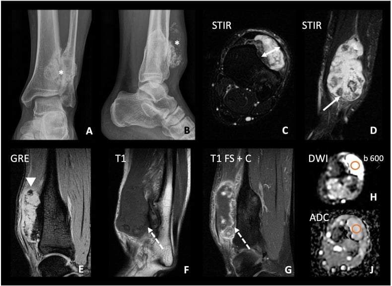 Radiographs and multiparametric MRI of low-grade secondary chondrosarcoma arising in an osteochondroma