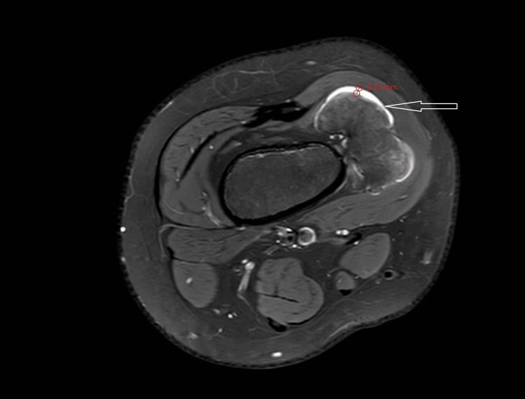 Axial fat-suppressed MRI showing a sessile distal-femoral osteochondroma with a 2.23 millimetre cartilage cap measurement