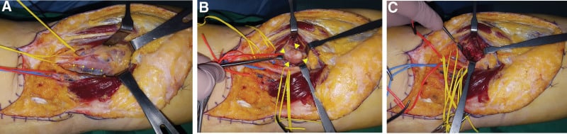 Intraoperative sequence showing tibial nerve compression by a fibular-head osteochondroma and decompression after excision