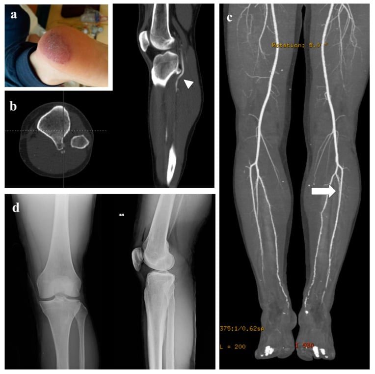 CT and CT angiography showing posterior tibial osteochondroma compressing the popliteal artery with thrombosis