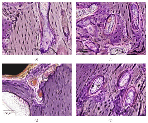 Four-panel H&E histology of bone undergoing remodeling, scale bars 50 micrometres