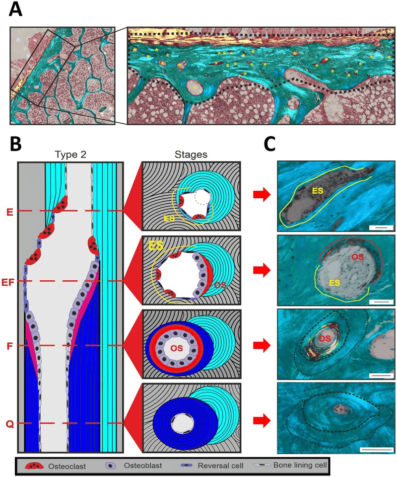 Masson-stained human iliac-crest biopsy and schematic of intracortical remodelling stages E, EF, F and Q (eroded, reversal, formative, quiescent) with matching histological cross-sections