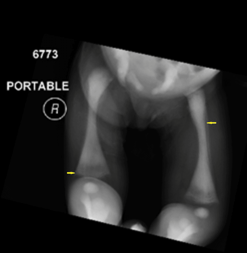 Portable radiograph of both femora showing osteosclerosis and metaphyseal flaring in infantile osteopetrosis, yellow arrows on each femur