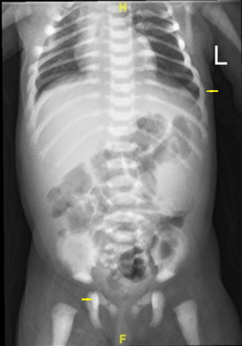 Chest and abdominal radiograph showing generalised increased bone density and widened ribs in infantile osteopetrosis, yellow arrows on a lower left rib and the right proximal femur