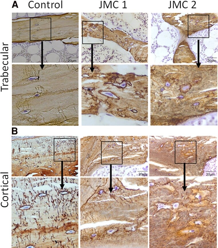 Silver-stained human trabecular (A) and cortical (B) bone comparing dense, orderly osteocyte canaliculi in a control with sparse, disorganised canaliculi in two Jansen disease samples.