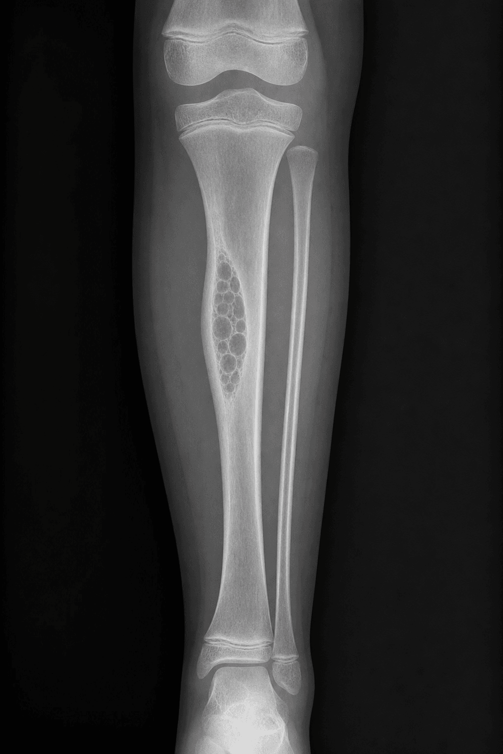 AP lower-leg radiograph showing a bubbly, multiloculated lucent intracortical lesion in the anterior tibial diaphysis with mild bowing, characteristic of osteofibrous dysplasia.