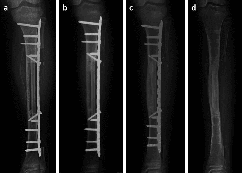 Serial radiographs, panels a to d, of intercalary reconstruction after wide resection of OFD-like adamantinoma