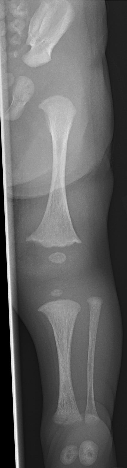 Newborn lower-limb radiograph in osteogenesis imperfecta showing gracile, undermineralised long bones with thin cortices and deformity.