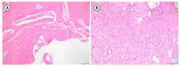 Low- and high-power histology of osteoid osteoma showing a sharply demarcated nidus of woven-bone trabeculae rimmed by osteoblasts.