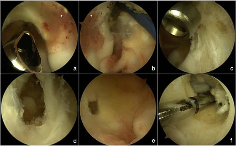 Arthroscopic sequence showing visualisation and complete ablation of an intra-articular osteoid osteoma in the coronoid and olecranon fossae.