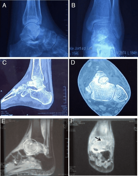 Talar osteoid osteoma with multimodality imaging