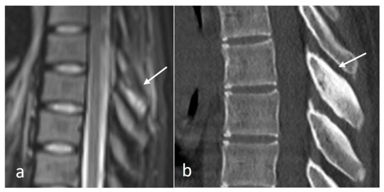Sagittal STIR MRI and CT of thoracic spinous-process osteoid osteoma showing extensive marrow oedema and reactive sclerosis.