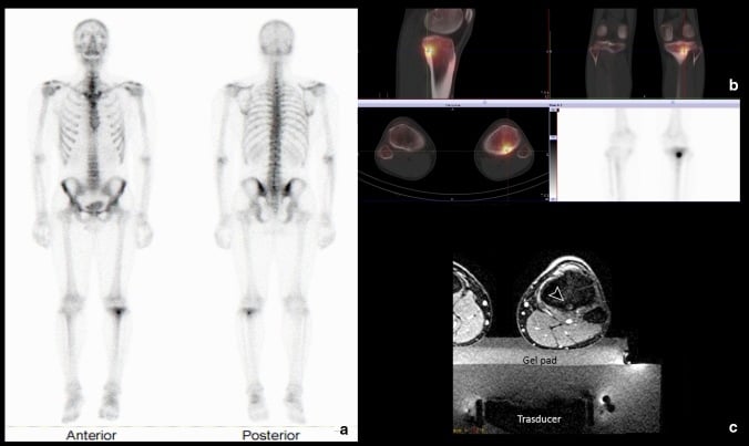 Technetium bone scan and SPECT-CT of proximal tibial osteoid osteoma showing the double-density sign and focal tracer uptake at the nidus.