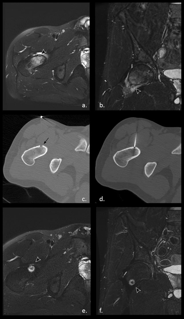 MRI, CT and radiofrequency ablation sequence for femoral-neck osteoid osteoma showing oedema, joint effusion, the nidus and probe placement.