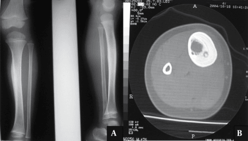 Classic tibial osteoid osteoma on X-ray and CT