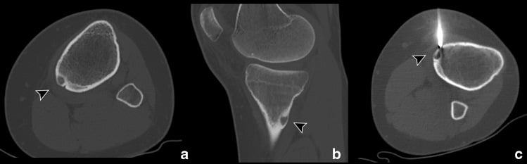Axial and sagittal CT of tibial osteoid osteoma with CT-guided bone drill and biopsy cannula approaching the nidus for radiofrequency ablation.