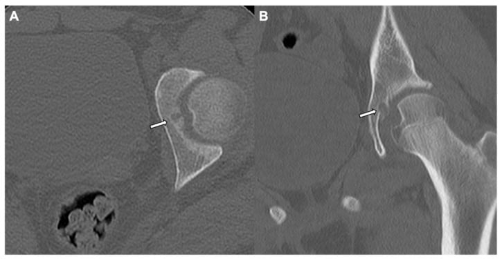 Axial and coronal CT of subperiosteal intra-articular osteoid osteoma at the superomedial acetabulum without surrounding sclerosis.