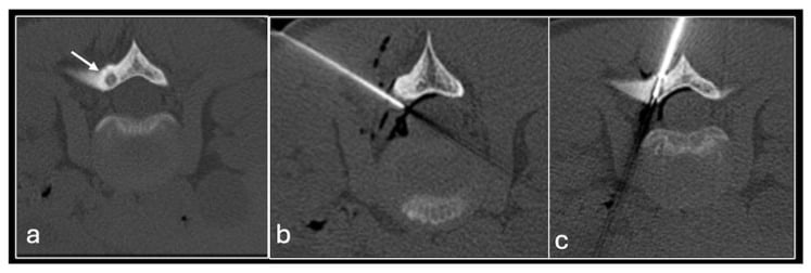 Axial CT sequence of lumbar spinal osteoid osteoma treated by radiofrequency ablation with injected air separating the nidus from neural structures.