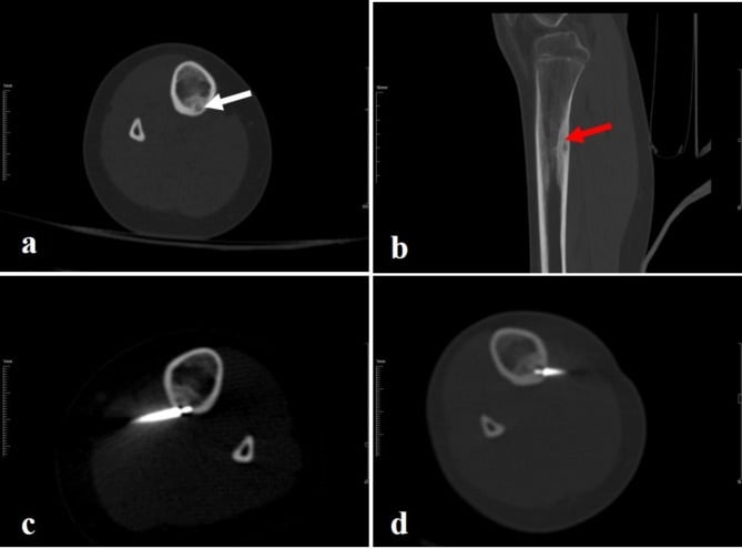 CT sequence of recurrent proximal tibial osteoid osteoma after radiofrequency ablation with repeat probe placement in the residual nidus.