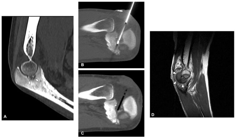 CT-guided cryoablation of elbow osteoid osteoma showing the probe within the nidus and the low-attenuation ice ball, with follow-up MRI.