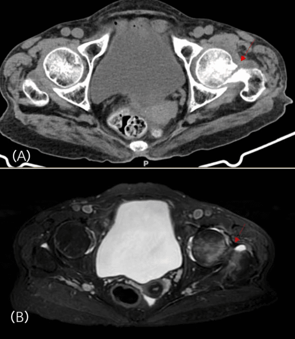 Axial CT and MRI of the pelvis in hypophosphataemic osteomalacia, with arrows at the left hip