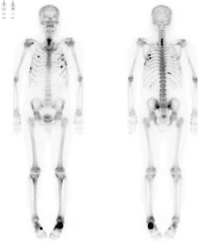 Whole-body bone scintigraphy in hypophosphataemic osteomalacia