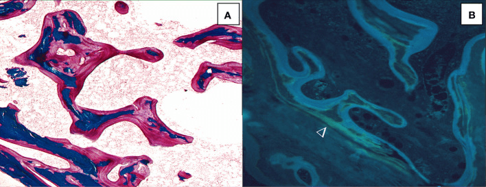 Thick osteoid seams and diffuse tetracycline labelling in osteomalacia