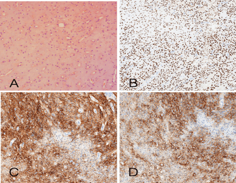 Histology and immunophenotype of a phosphaturic mesenchymal tumour