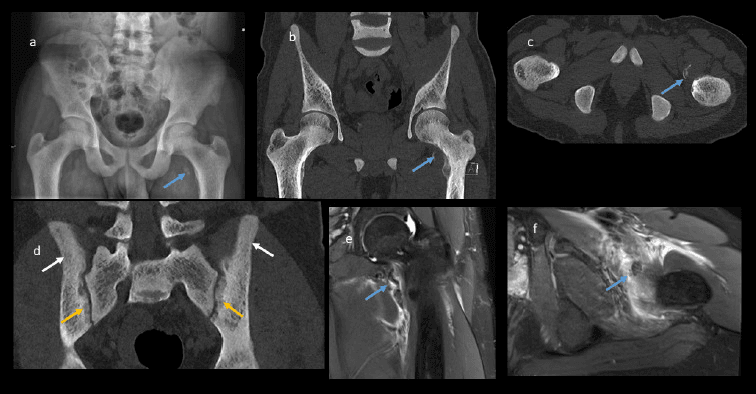 Avulsion fractures with sclerosis and subperiosteal resorption in renal osteodystrophy