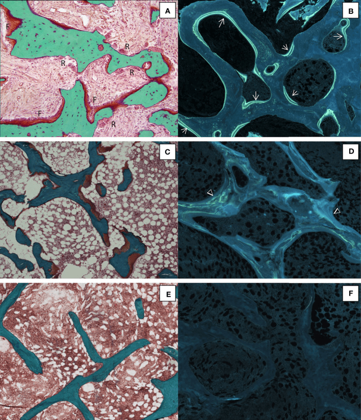 Histomorphometric patterns of renal osteodystrophy