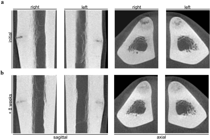 Cone-beam CT of bilateral tibial Looser zones, right and left, sagittal and axial, initially and 8 weeks later