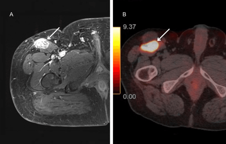 MRI and DOTATATE PET localisation of a phosphaturic mesenchymal tumour