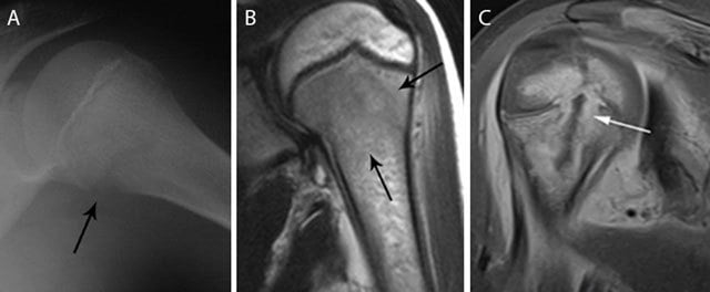 Radiograph and contrast-enhanced MRI examples of acute proximal humeral osteomyelitis in children.