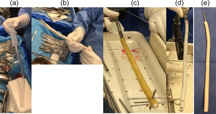 Operative sequence for manufacturing a custom antibiotic cement-coated intramedullary nail using a tube mould.