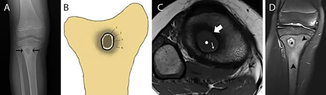 Radiograph, schematic and MRI of a metaphyseal Brodie abscess with surrounding sclerosis and target appearance.