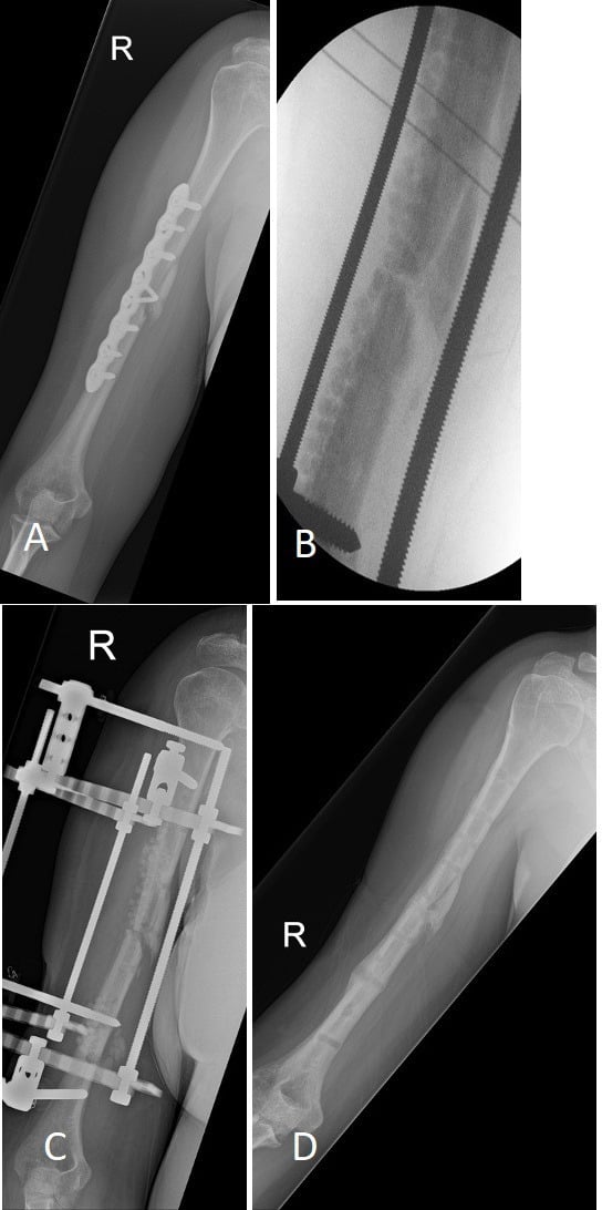 Serial radiographs of infected humeral nonunion treated with implant removal, local antibiotics, external fixation and union-preserving debridement.