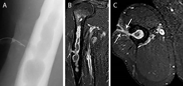 Sinogram and contrast-enhanced MRI of chronic humeral osteomyelitis showing a sinus tract communicating with the medullary lesion.