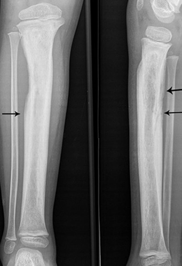 Anteroposterior and lateral tibial radiographs showing extensive involucrum in chronic osteomyelitis.