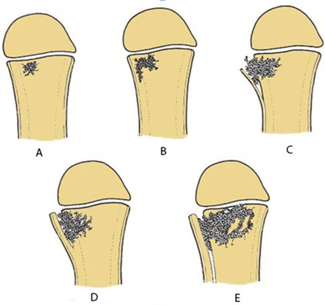 Five-stage schematic of metaphyseal osteomyelitis progressing from an initial focus to cortical breach, periosteal elevation and involucrum formation.