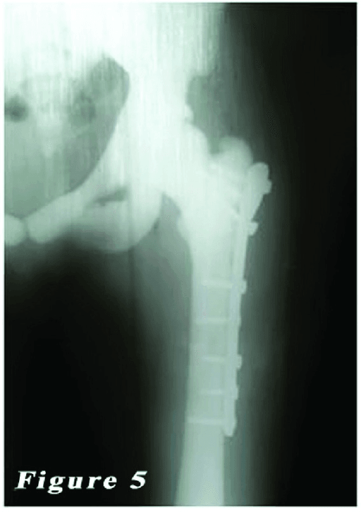 Postoperative femur radiograph showing plate fixation for osteopetrosis fracture