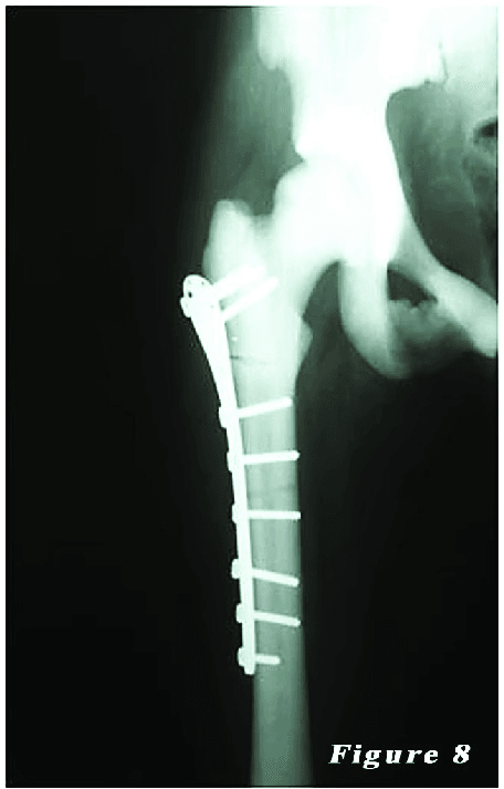 Postoperative femur radiograph showing plate fixation in osteopetrosis