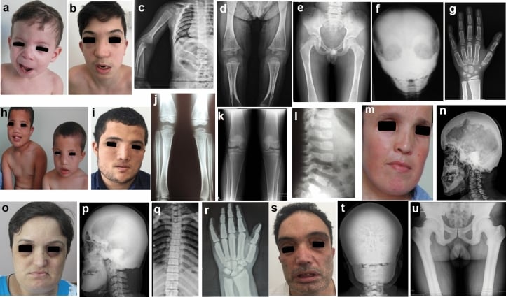 Radiograph series demonstrating generalized marble bone sclerosis and sandwich vertebrae