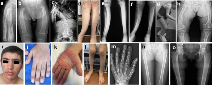 AP and lateral radiographs demonstrating pathological femoral shaft fracture and intramedullary hardware fixation