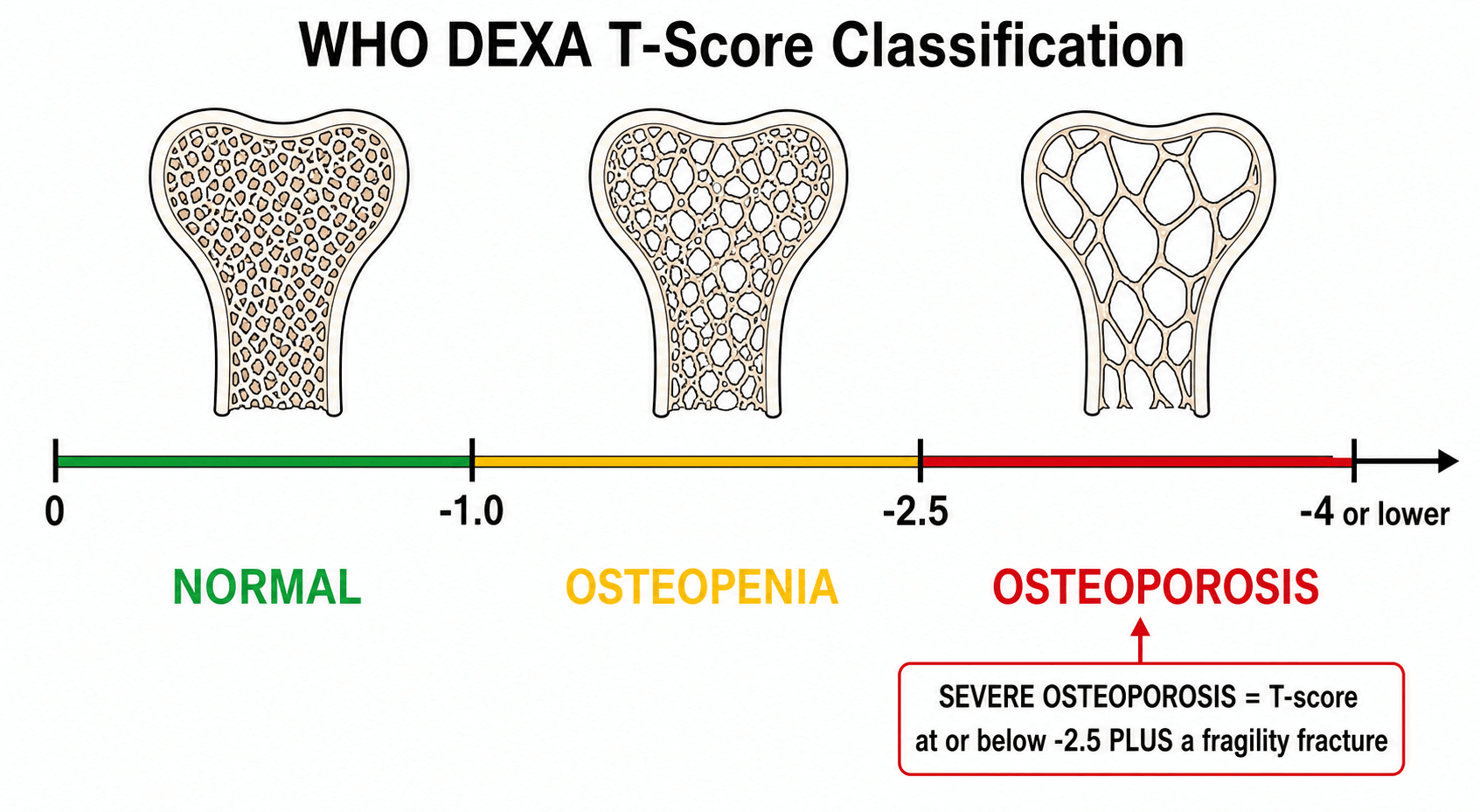 WHO DEXA T-score classification scale showing normal, osteopenia, and osteoporosis thresholds with progressive trabecular bone thinning icons