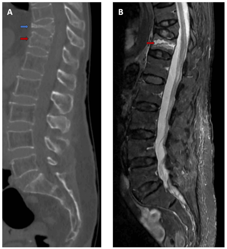 Sagittal CT and STIR MRI showing chronic T11 and acute T12 thoracic vertebral compression fractures