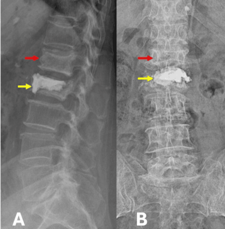 Post-vertebroplasty lumbar radiographs showing new adjacent-level compression fracture