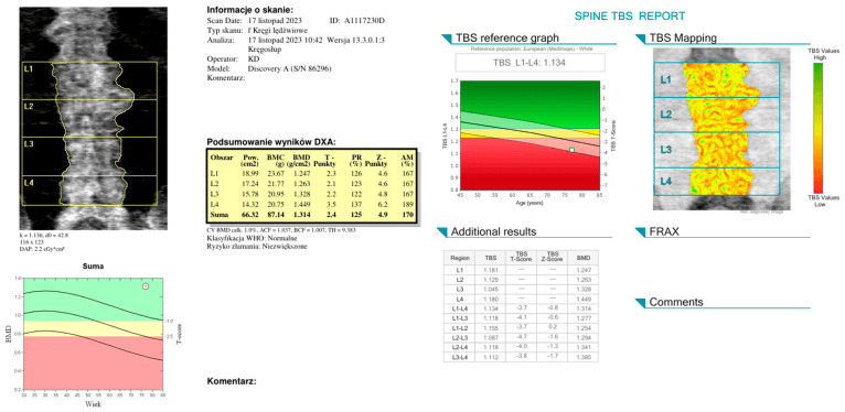 Lumbar DXA and trabecular bone score report showing normal BMD but degraded microarchitecture