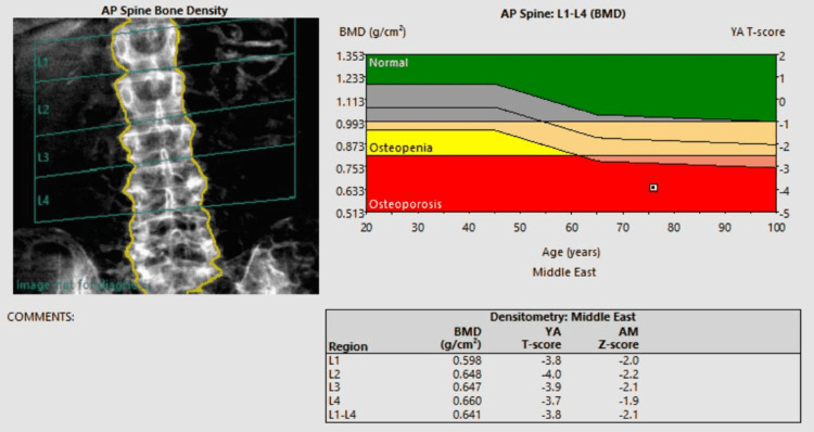Lumbar spine DXA report showing T-score in the osteoporosis range